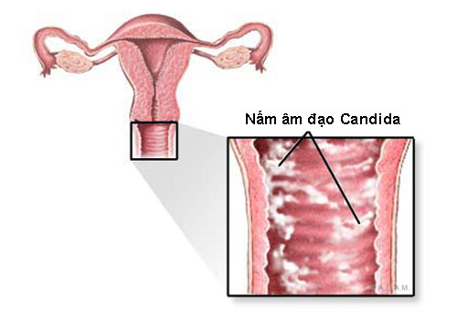 Chữa nấm Candida tại nhà - Liệu trình chỉ từ 245k