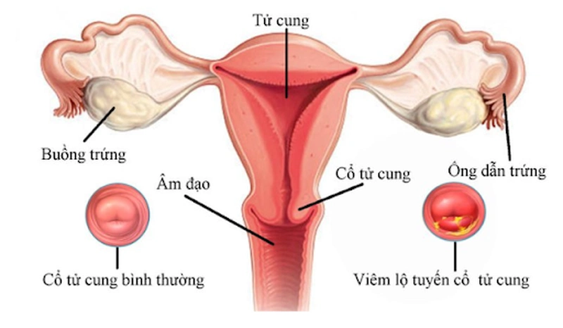 Khí hư là gì - Những điều phụ nữ quan tâm