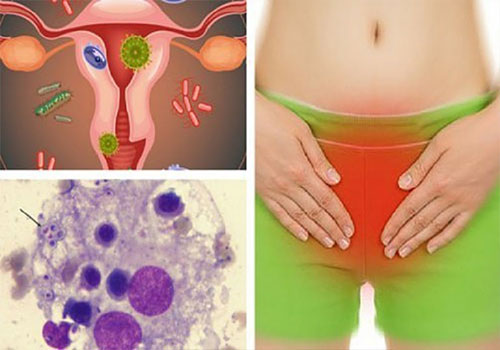 Nám candida có nguy hiểm không - Những điều cần lưu ý