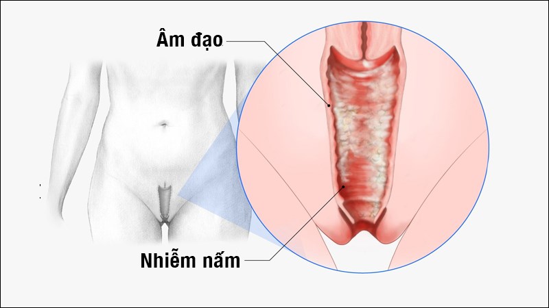 Uống gì để hết viêm phụ khoa - 3 thức uống không thể bỏ qua