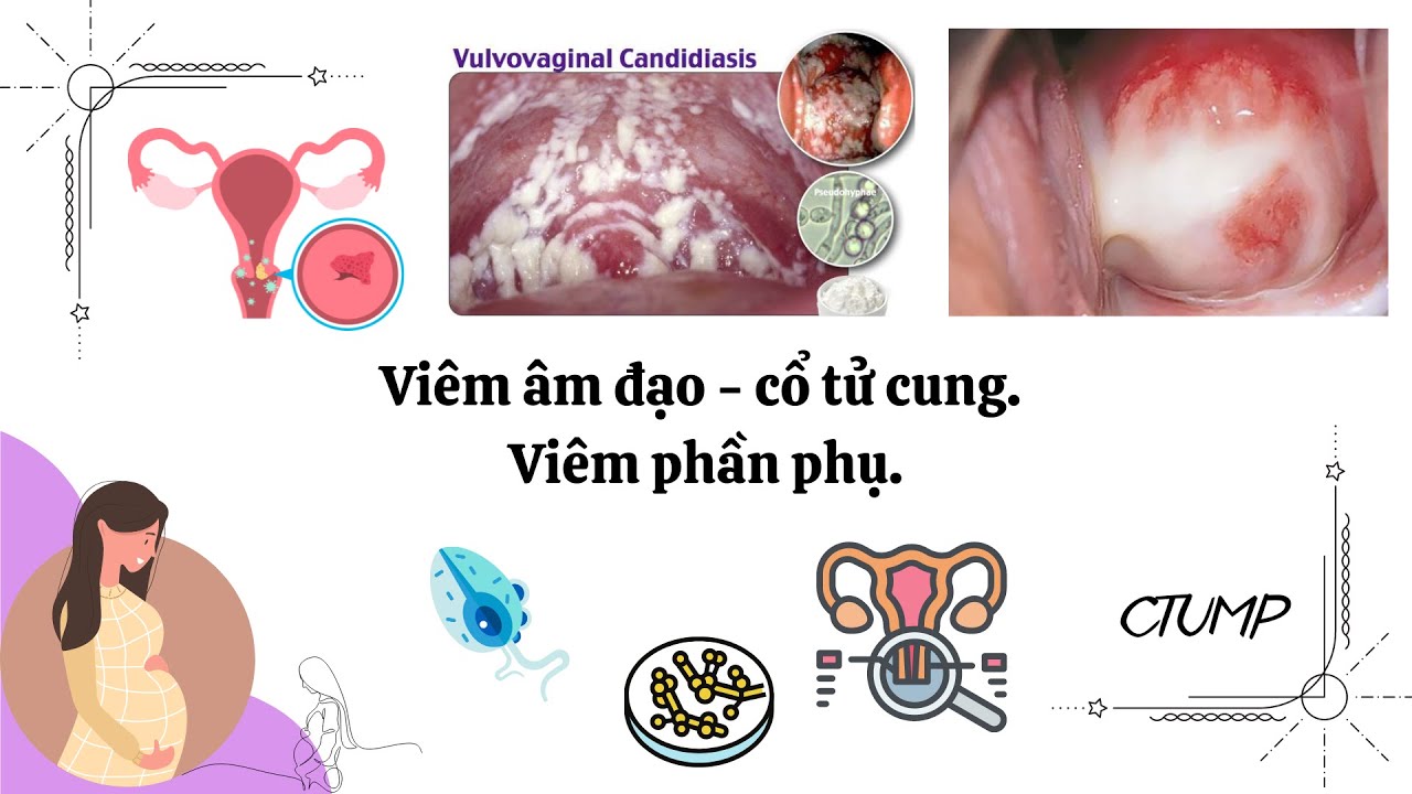 Viêm phần phụ - Các nguyên nhân chính và 4 biểu hiện cần quan tâm