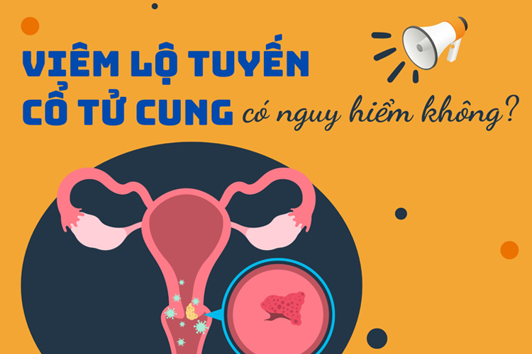 Viêm cổ tử cung - Nguyên nhân và triệu chứng