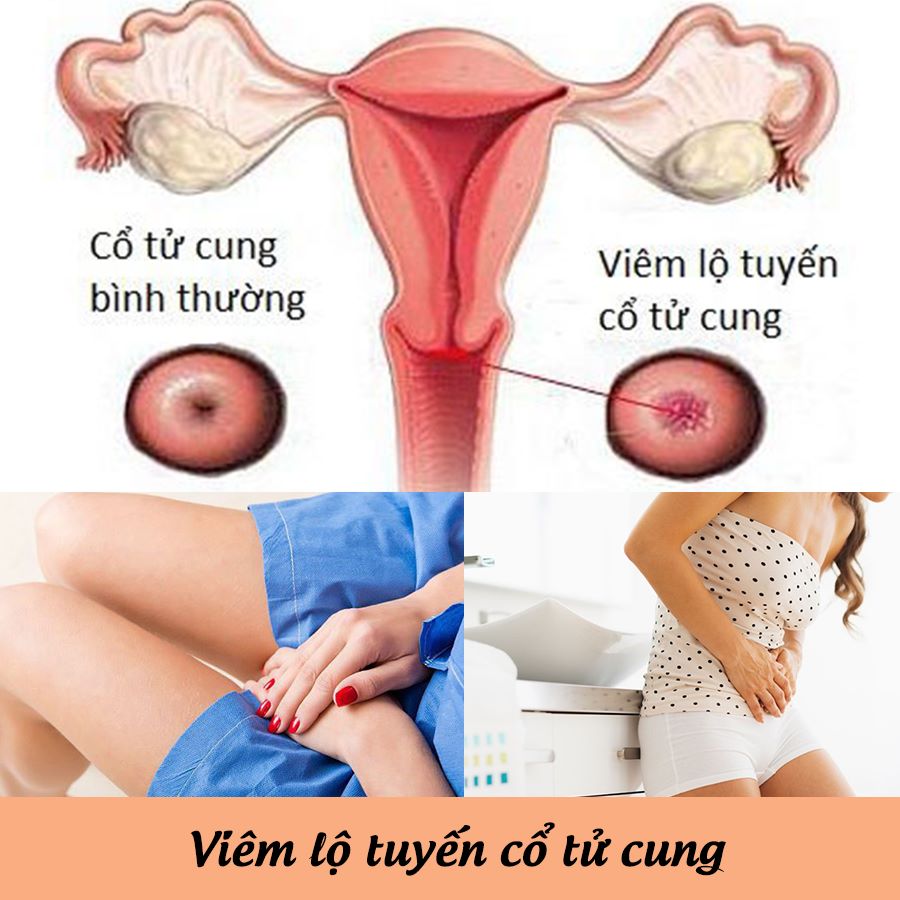 Viêm lộ tuyến cổ tử cung: Khái niệm và nguyên nhân